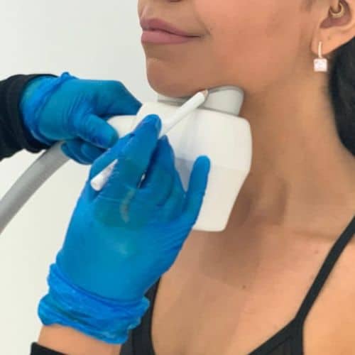 fat freezing double chin slim face