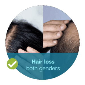 hair loss in both genders