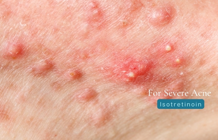 severe acne Isotretinoin accutane