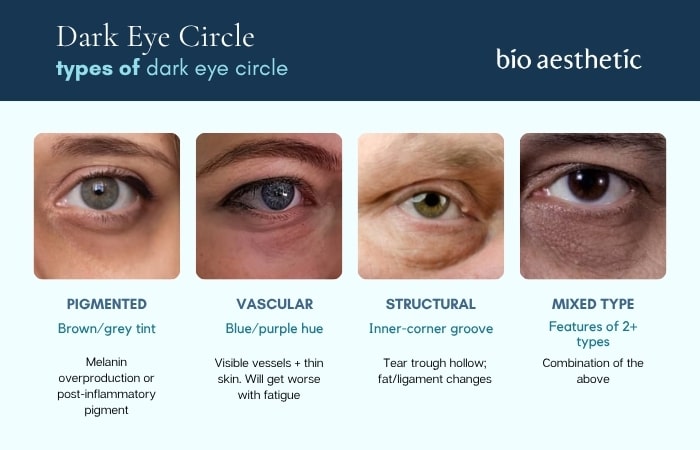 types of dark eye circle