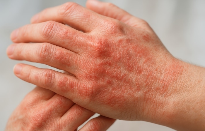 Eczema