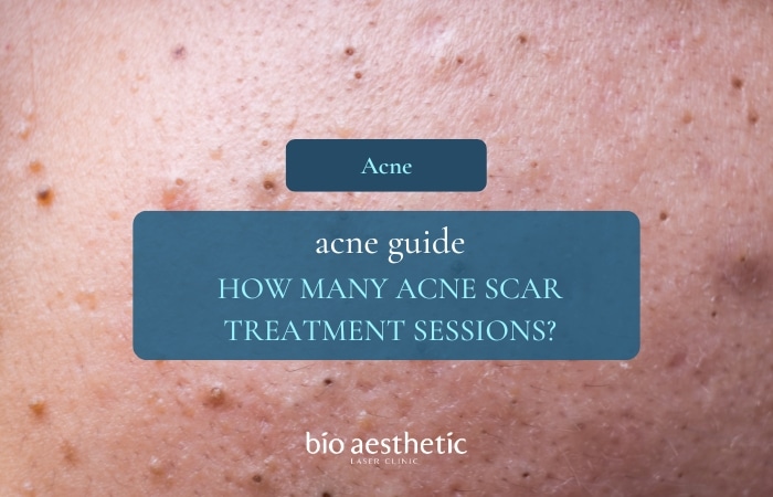 Whiteheads vs Blackheads types of acne explained