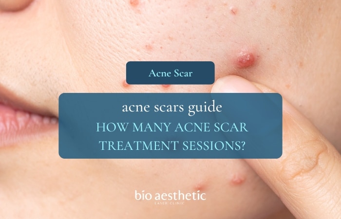 Why Acne Flares in Singapore Humidity (and What Actually Helps)