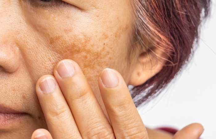 pigmentation removal singapore price