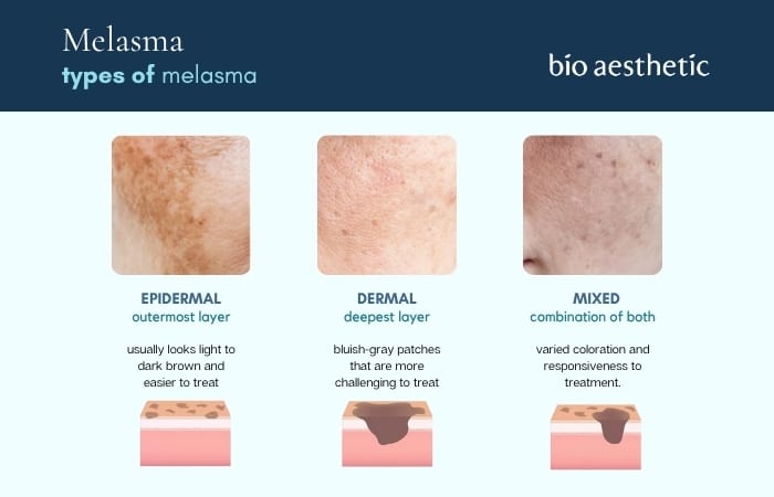 what are the different types of melasma