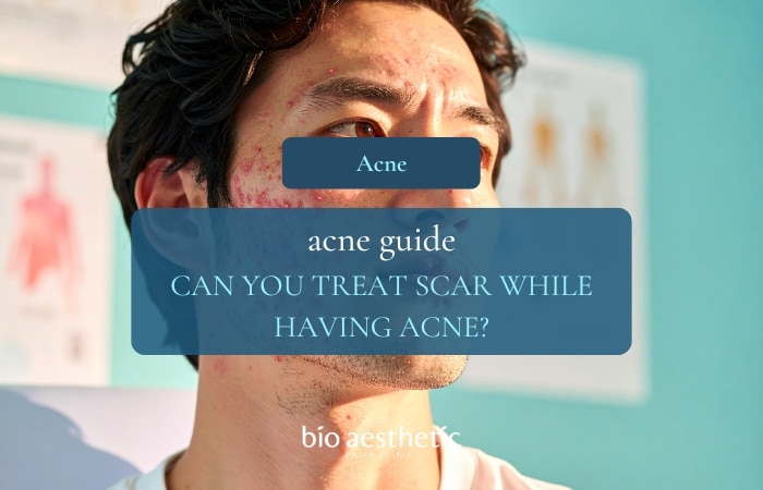 Can You Treat Scars If You Still Have Active Acne?