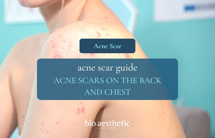 back acne scar treatment