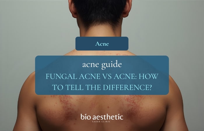 fungal acne vs acne singapore