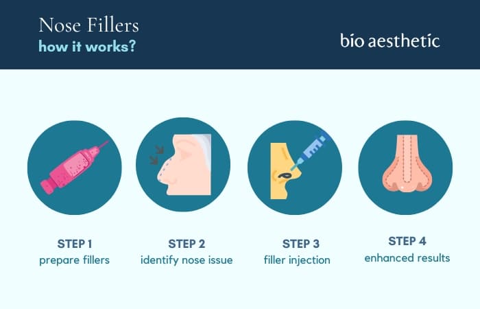 how does nose filler work?