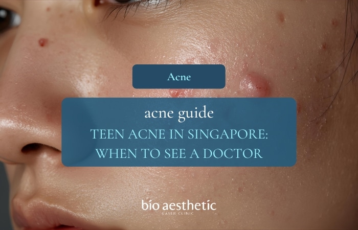 teen acne in singapore when to see a doctor
