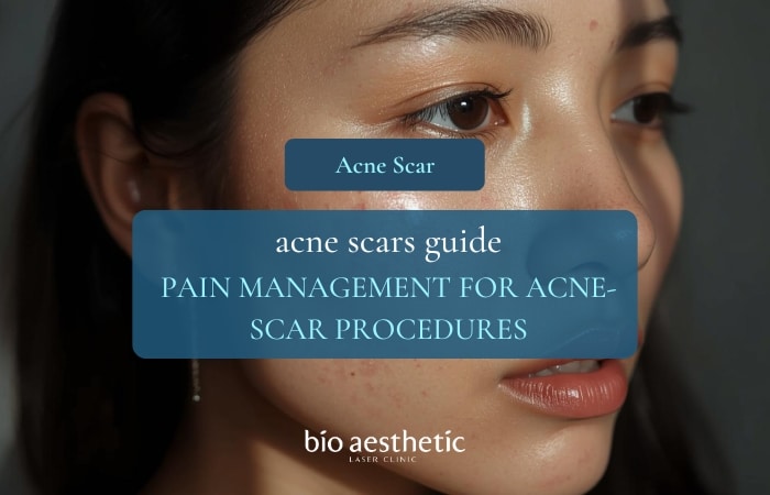 Pain Management for Acne Scar Procedures subcision anesthesia