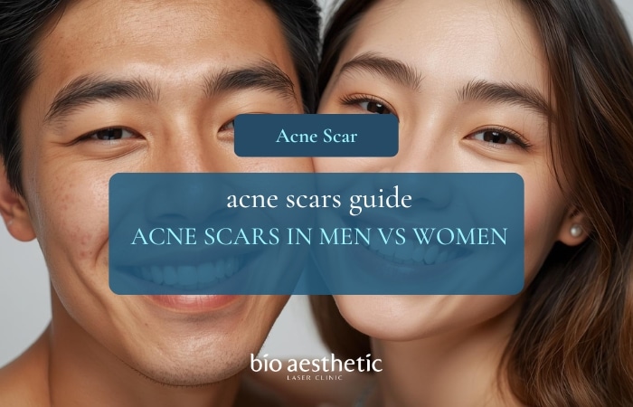 acne scars in men vs women