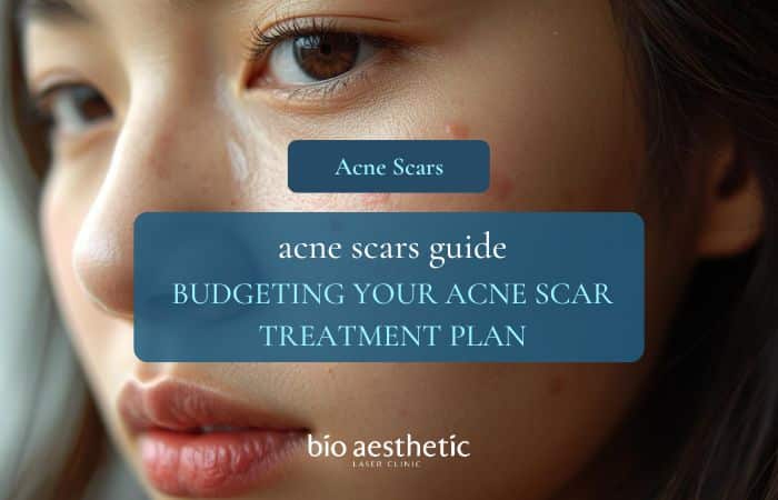 budgeting your acne scar treatment plan