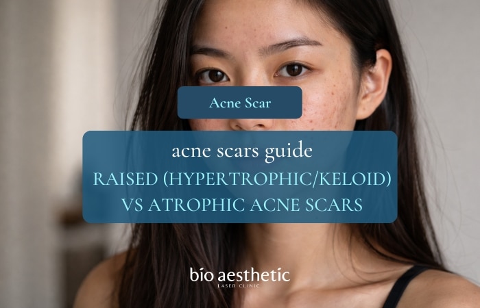 raised vs atrophic acne scars