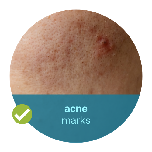 Acne Marks & Scars