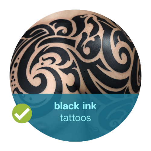Black tattoo removal