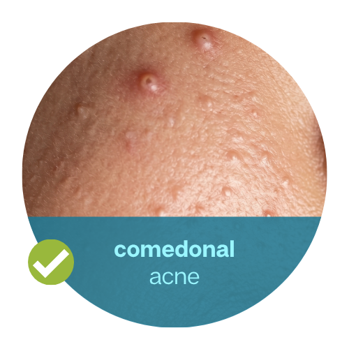 Comedonal Acne