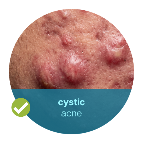 Cystic Nodulocystic Acne