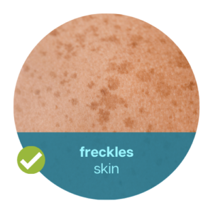 freckles