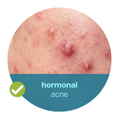 Hormonal-Pattern Acne