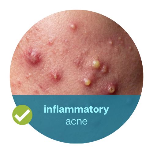 Inflammatory Acne