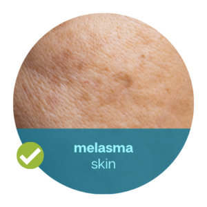 melasma