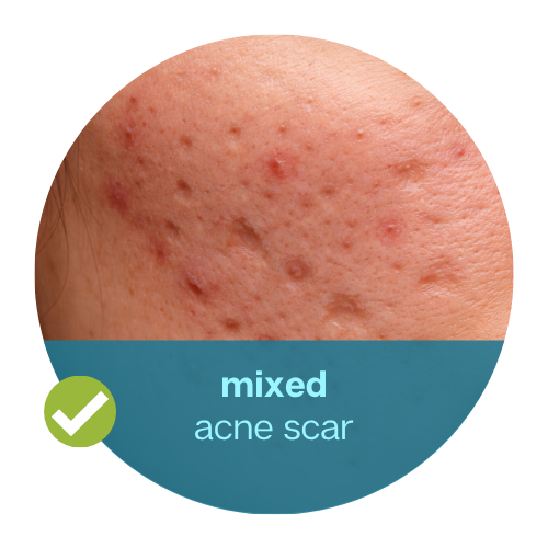 Mixed Acne Scars