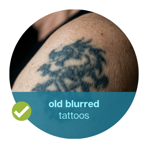 Old or blurred tattoo removal