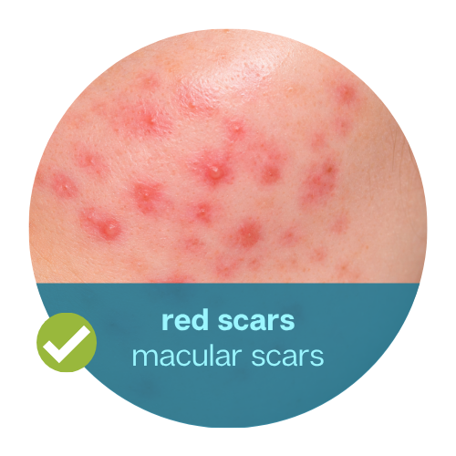 Acne Marks