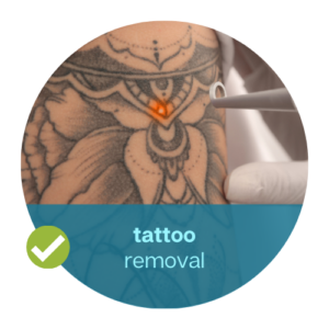 tattoo removal