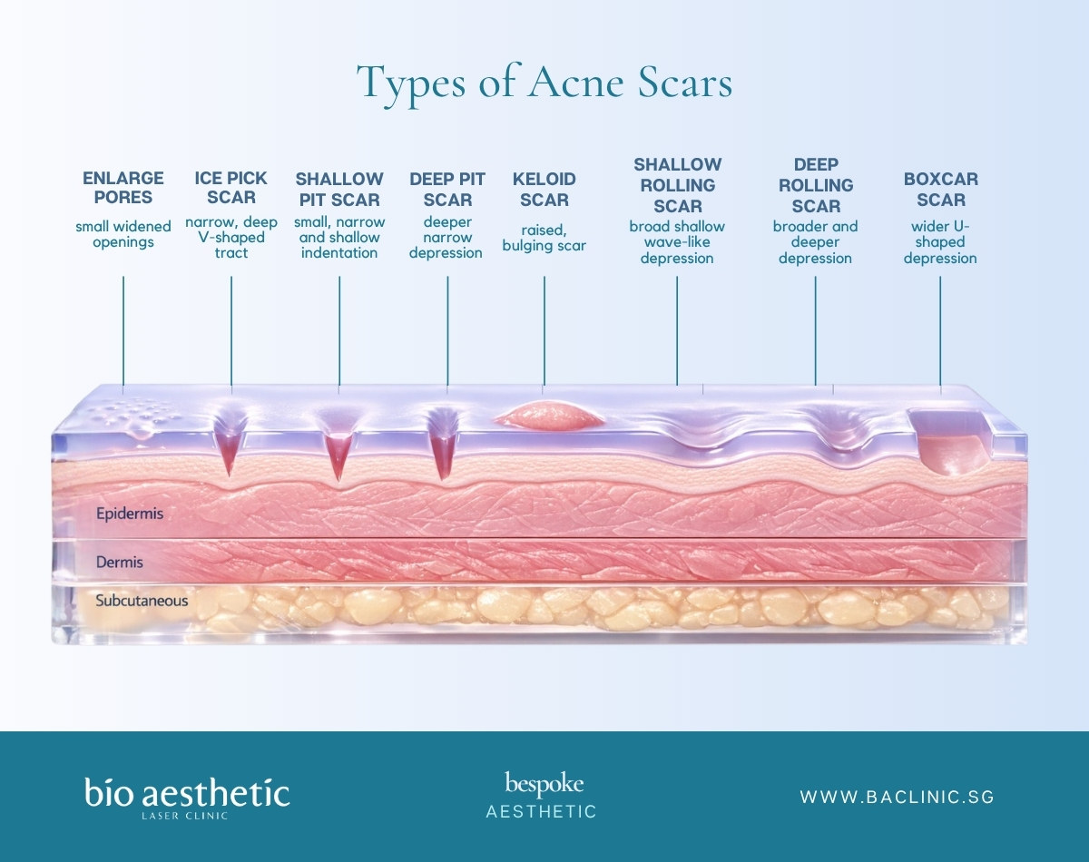 Acne scar texture assessment Singapore