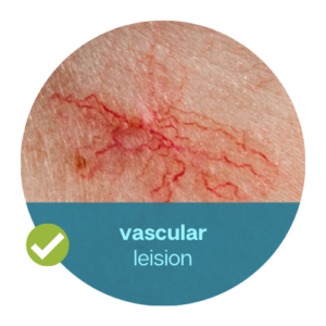 vascular lesion